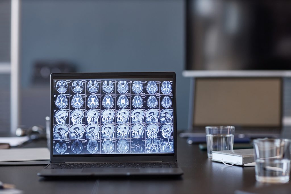 Radiologists Laptop Displaying X Ray Scan of Human Brain on Table in Clinic